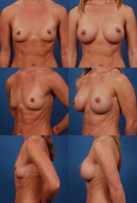 Think, that pennsylvania breast implant augmentation Remarkable pennsylvania breast implant augmentation consider, that