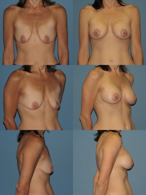 Nipple repositioning during breast lift in Dallas