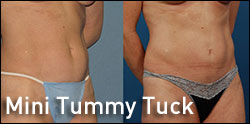 mini tummy tuck gallery