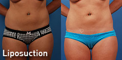 liposuction gallery