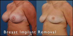 breast implant removal gallery
