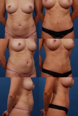 Patient before and After a Mini Tummy Tuck in Dallas
