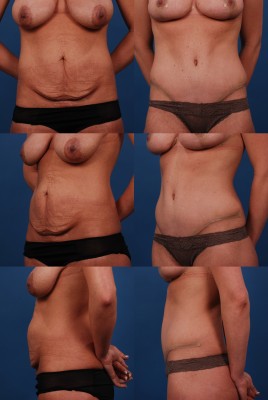 Patient before and after a full abdominoplasty in Dallas, Texas