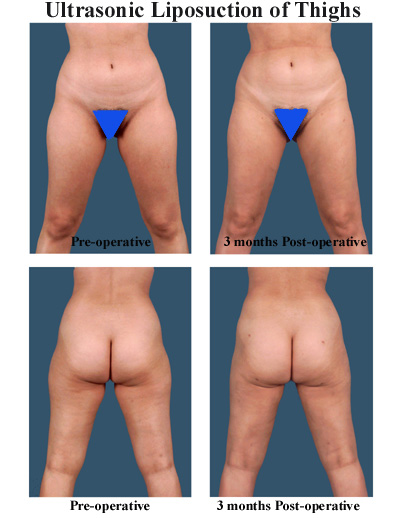 Before and after liposuction of the thighs in Dallas, Texas