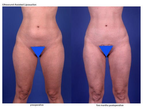 Before and after liposuction of the hips and thighs in Dallas