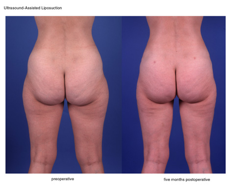 Ultrasonic assisted lipoplasty of the thighs in Dallas