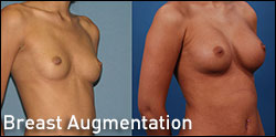 breast augmentation plastic surgery photo gallery