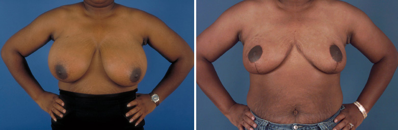 Breast reduction before and after picture