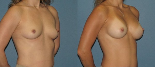 breast augmentation before and after picture in dallas