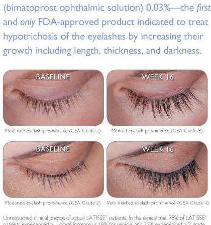 Latisse eyelash growth