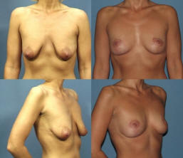Breast lift before and after picture in Dallas, Texas