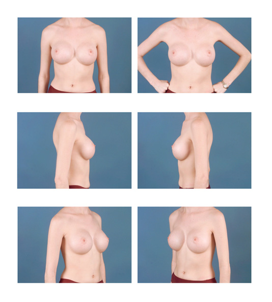 breast surgery online consult photo standards