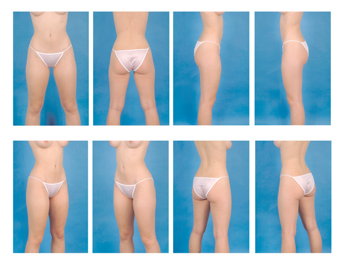 liposuction body contouring online consult photo standards