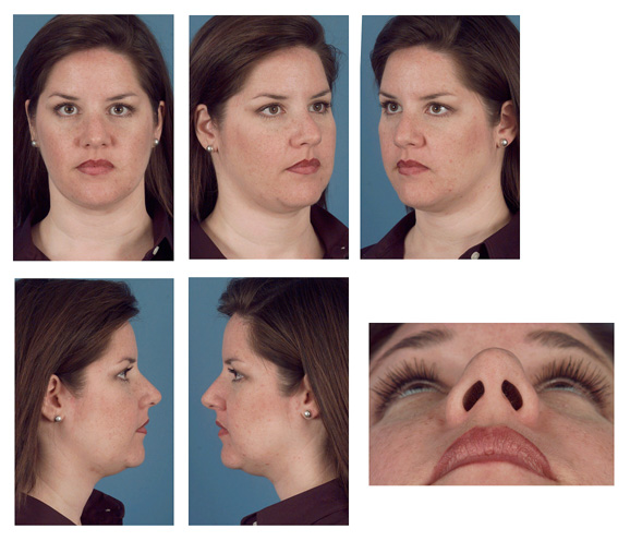 nose rhinoplasty online consult photo standards