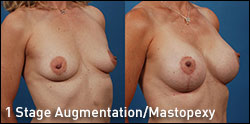 1-stage augmentation/mastopexy gallery