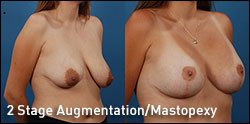 2-stage augmentation/mastopexy gallery