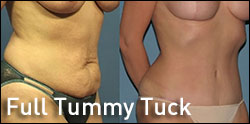 full tummy tuck gallery
