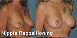 nipple repositioning gallery