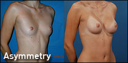 breast augmentation gallery asymmetry