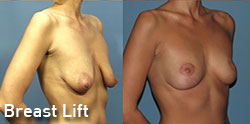 breast lift gallery