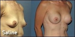 saline breast implant gallery