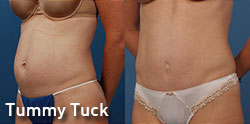 tummy tuck gallery