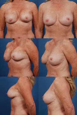 Patient with breast implant capsualar contracture, before and after she received breast revision surgery