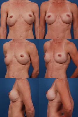 Before and after revision breast augmentation with breast implants in Dallas, Texas