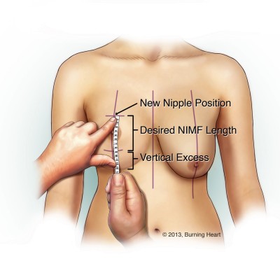 A graphic representation of the augmentation mastopexy re-visited