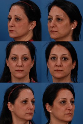 Patient Theresa Powers before and after being treated with injectable fillers