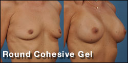 silicone gel breast implant gallery
