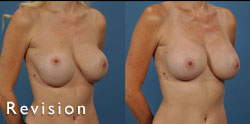 breast augmentation revision plastic surgery photo gallery