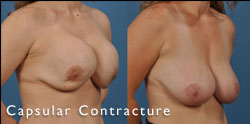 capsular contracture gallery