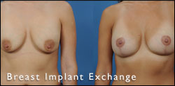 breast exchange gallery