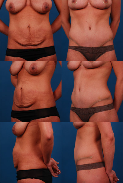 tummytuck-img1
