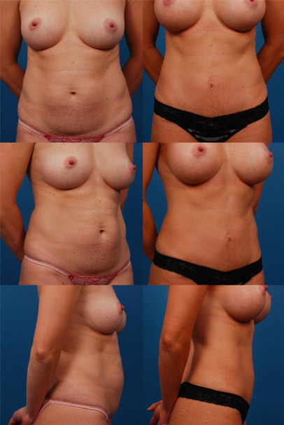 tummytuck-img2