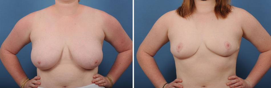 breastreduction-image2